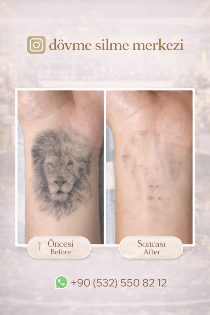 dövme silme istanbul