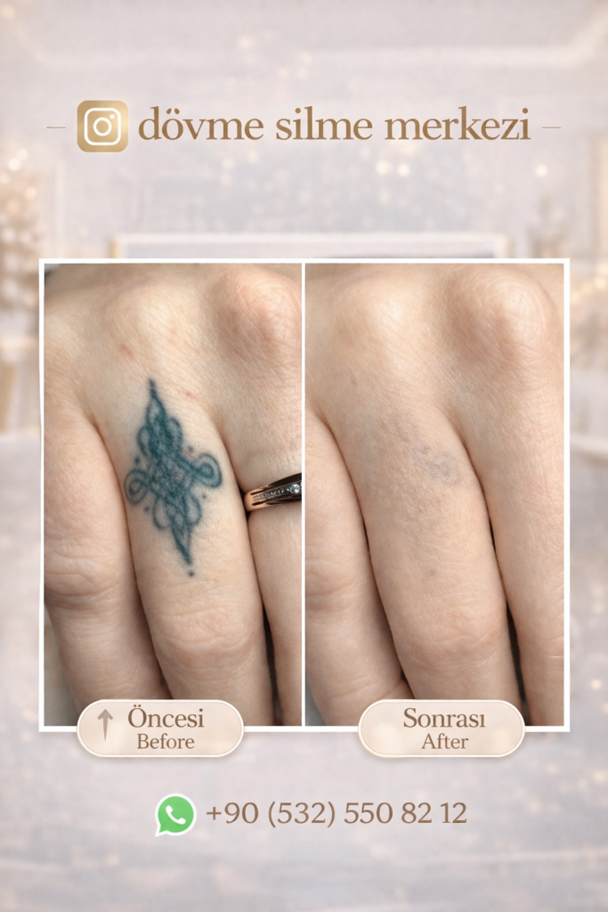 dövme silme istanbul