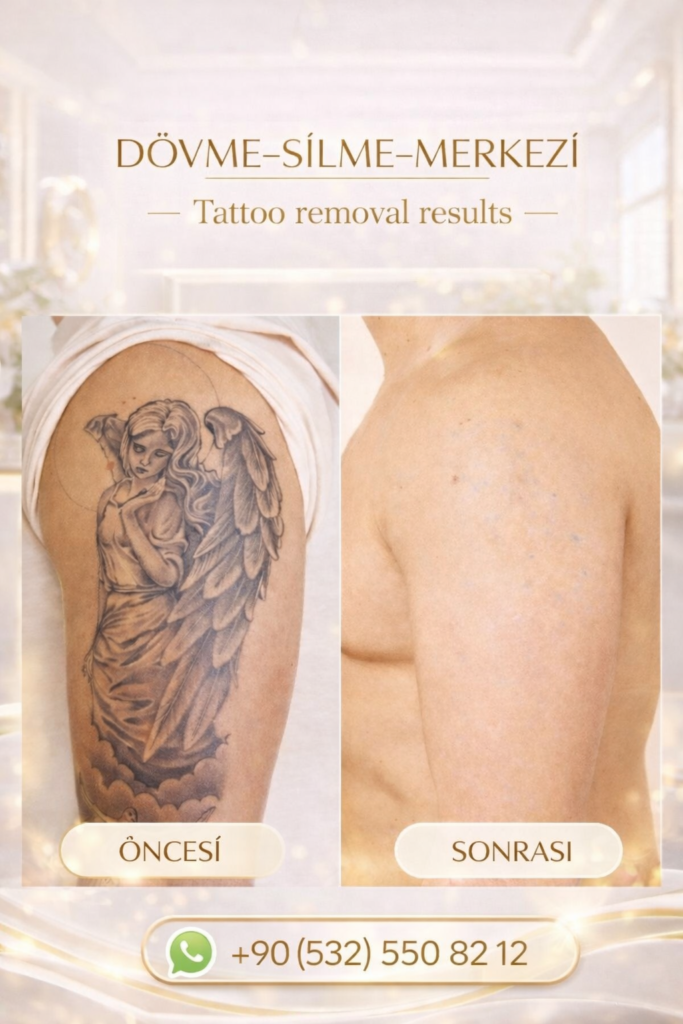 dövme silme istanbul
