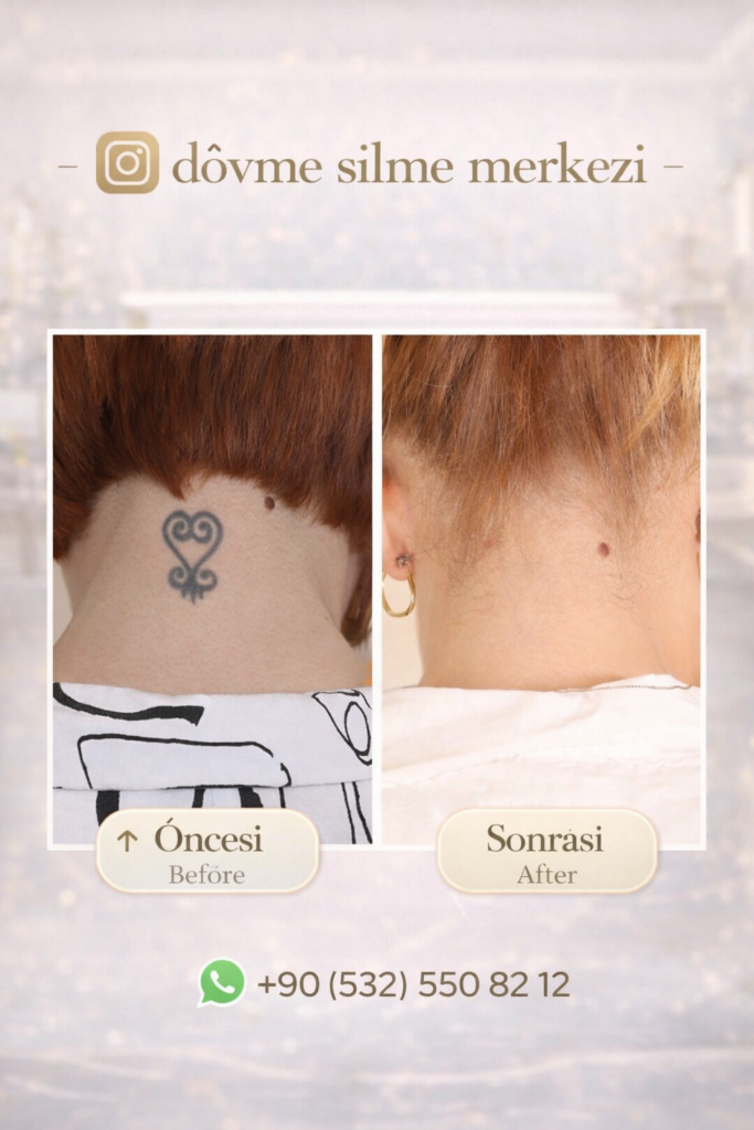 dövme silme istanbul