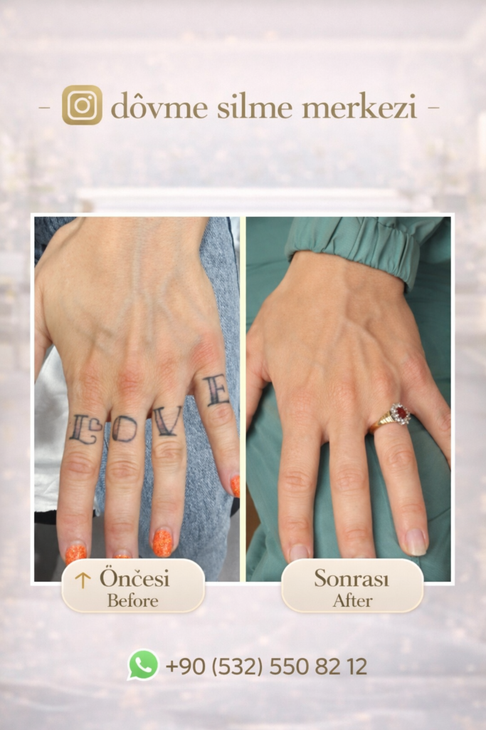 dövme silme istanbul