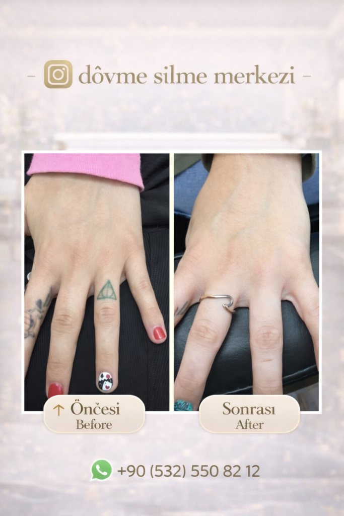 dövme silme istanbul